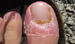 De behandeling van de nagel schimmel