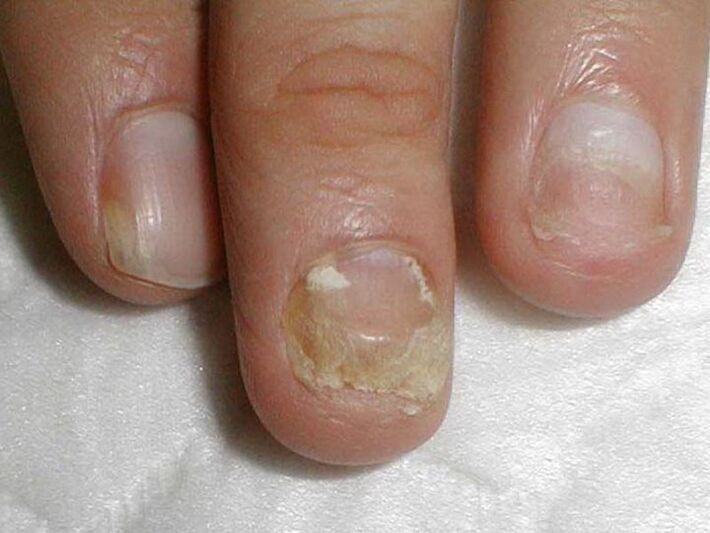 Candida nagel schimmel behandeling