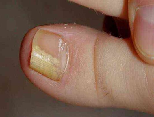 distale laterale vorm van nagelschimmel