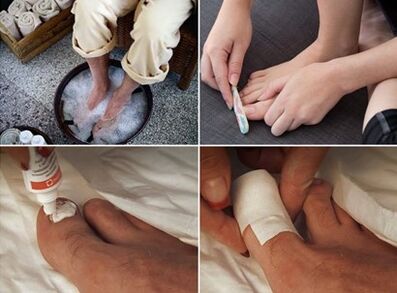 Voeten stomen en ureumcrème aanbrengen op door schimmel aangetaste nagels