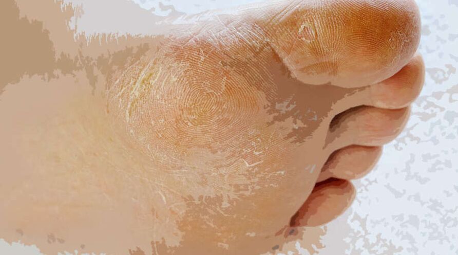 Mycose van de voet