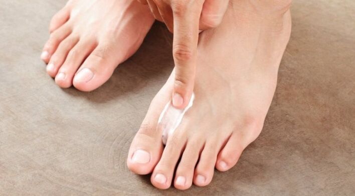 hoe en hoe de schimmel tussen de tenen te behandelen