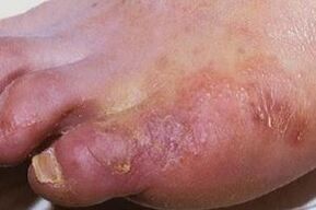 manifestaties van een schimmelinfectie op de huid van de benen