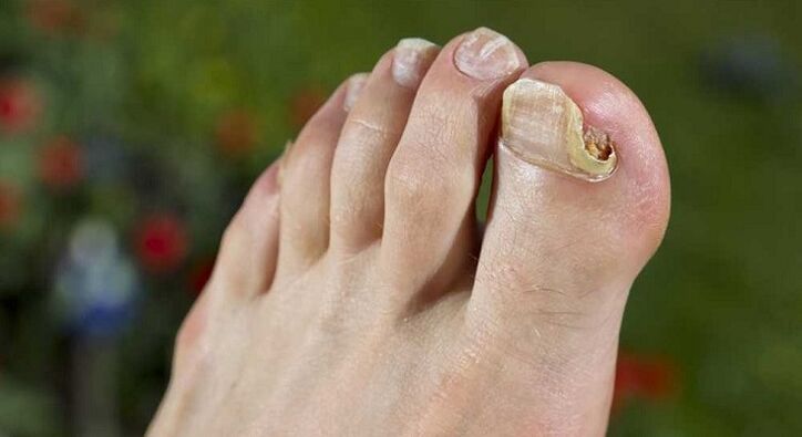 schade aan de nagelplaat met schimmel op de benen