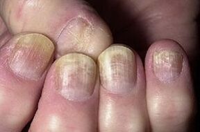 verandering in de nagel met schimmelinfectie