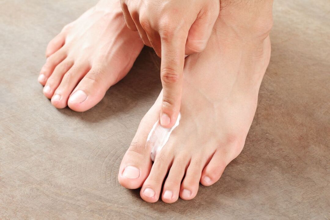 behandeling van schimmel op de voeten met zalf