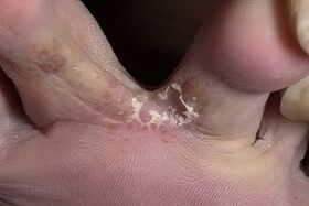 huidschimmel tussen de tenen