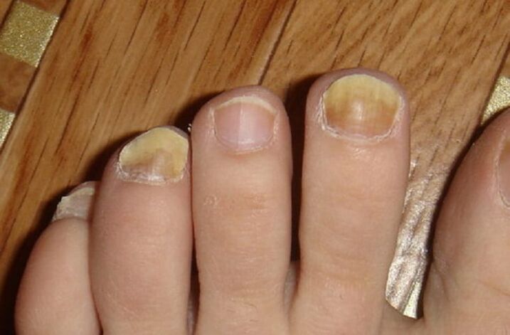 symptomen van schimmel op de nagels en de huid van de voeten