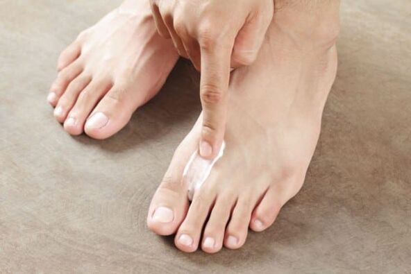 toepassing van zalf van de schimmel van de huid op de benen