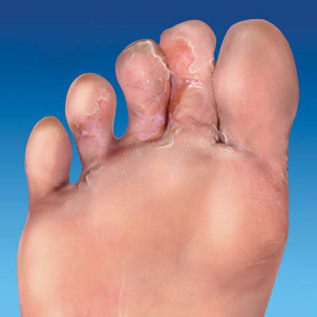 huid schimmel voeten