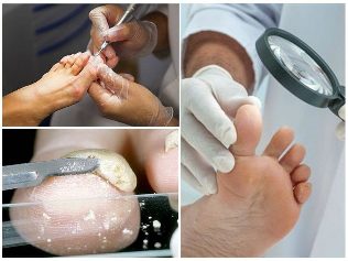 schimmel voet huid diagnose