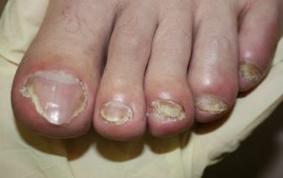 de symptomen van de nagel schimmel
